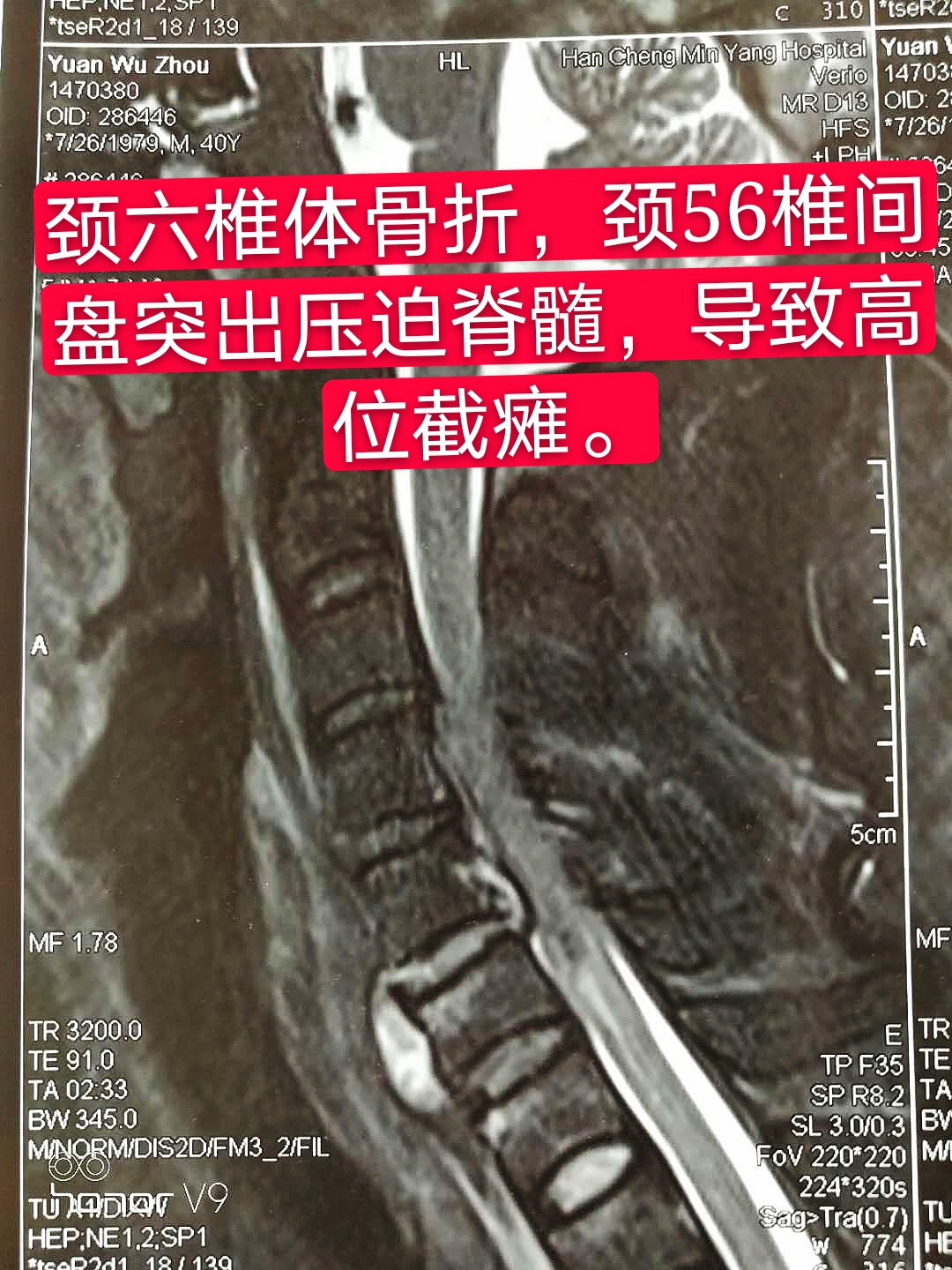 市第一院骨二科成功救治一例高位颈椎骨折并完全脱位患者获得成功_损伤