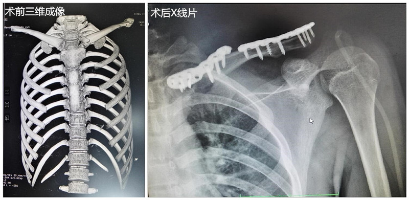 看似简单的锁骨骨折