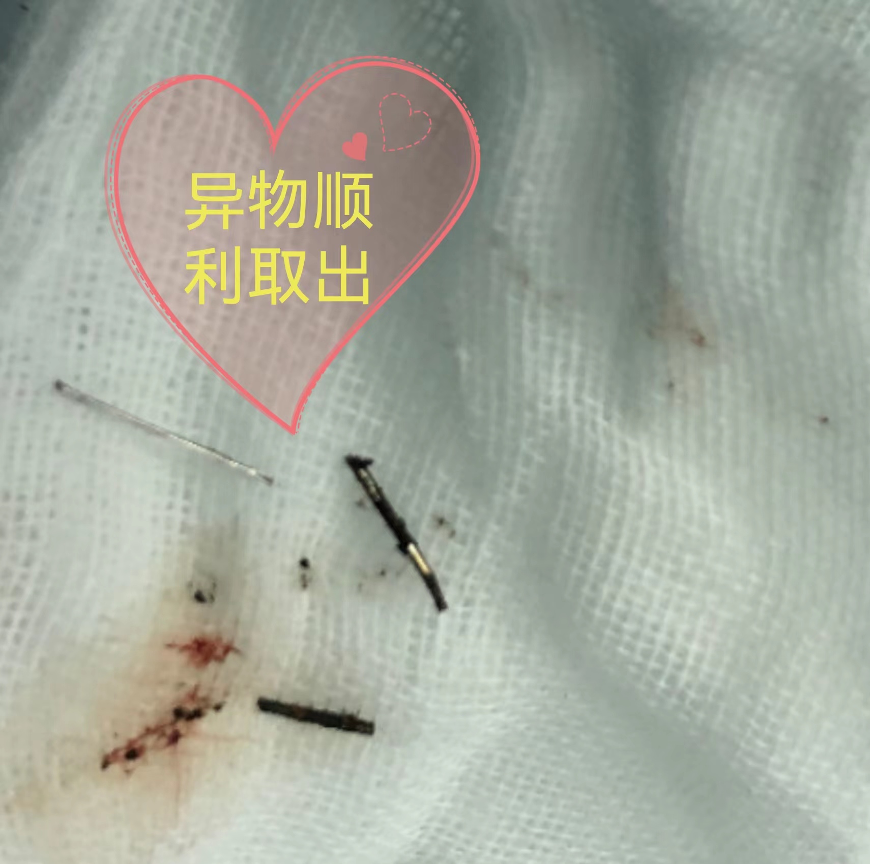 体内异物4年（手术）未取出,凤城医院普外腹腔镜微创祛顽疾-西安凤城医院[官网] 急救电话：029-86530966