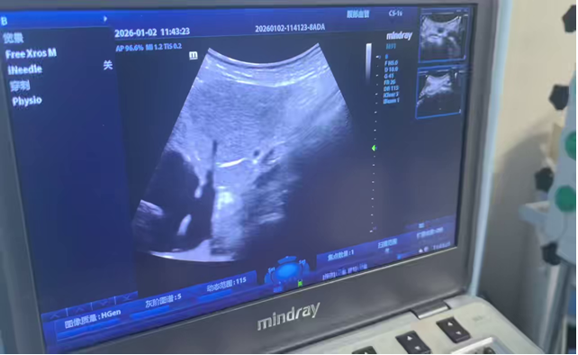 静亦求精、另辟蹊径——我院首例高难度下肢PICC导管成功置入