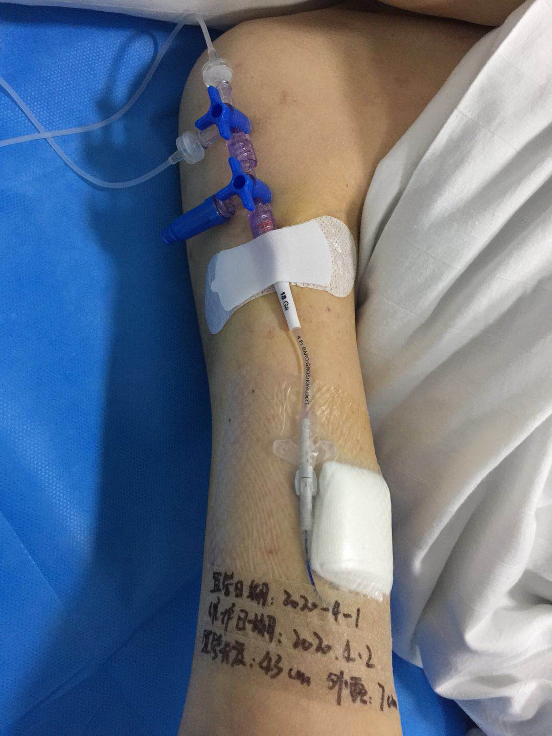 西安凤城医院 成功开展首例picc导管置入术